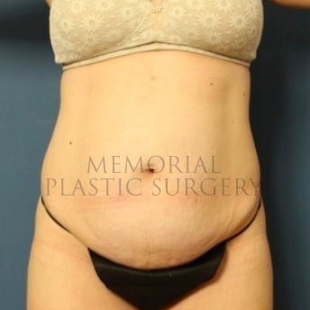 A front view before photo of patient 183 that underwent Abdominoplasty Tummy Tuck:Liposuction procedures at Memorial Plastic Surgery