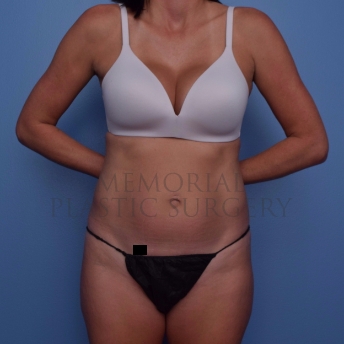 A front view before photo of patient 694 that underwent Abdominoplasty Tummy Tuck:Liposuction procedures at Memorial Plastic Surgery