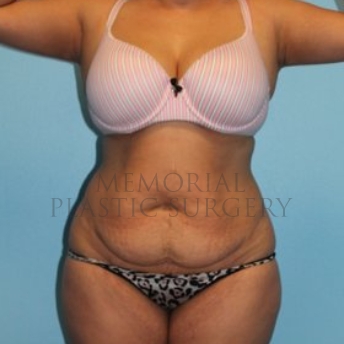 A front view before photo of patient 260 that underwent Abdominoplasty Tummy Tuck:Liposuction procedures at Memorial Plastic Surgery
