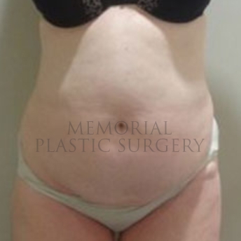 A front view before photo of patient 186 that underwent Abdominoplasty Tummy Tuck:Liposuction procedures at Memorial Plastic Surgery