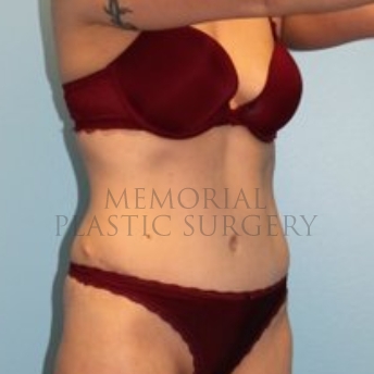 A oblique view after photo of patient 183 that underwent Abdominoplasty Tummy Tuck:Liposuction procedures at Memorial Plastic Surgery