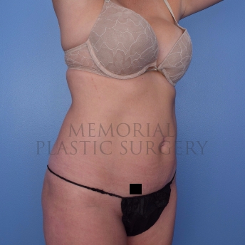 A oblique view after photo of patient 694 that underwent Abdominoplasty Tummy Tuck:Liposuction procedures at Memorial Plastic Surgery