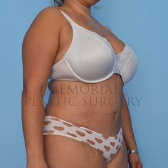 A oblique view after photo of patient 260 that underwent Abdominoplasty Tummy Tuck:Liposuction procedures at Memorial Plastic Surgery