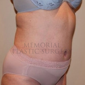 A oblique view after photo of patient 186 that underwent Abdominoplasty Tummy Tuck:Liposuction procedures at Memorial Plastic Surgery