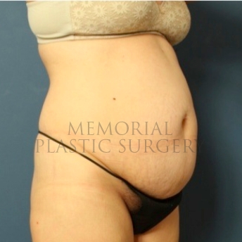 A oblique view before photo of patient 183 that underwent Abdominoplasty Tummy Tuck:Liposuction procedures at Memorial Plastic Surgery