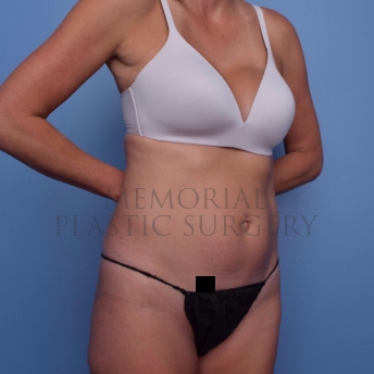 A oblique view before photo of patient 694 that underwent Abdominoplasty Tummy Tuck:Liposuction procedures at Memorial Plastic Surgery