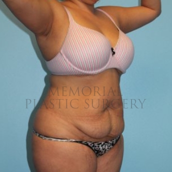 A oblique view before photo of patient 260 that underwent Abdominoplasty Tummy Tuck:Liposuction procedures at Memorial Plastic Surgery