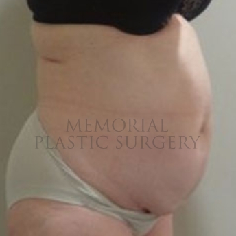A oblique view before photo of patient 186 that underwent Abdominoplasty Tummy Tuck:Liposuction procedures at Memorial Plastic Surgery