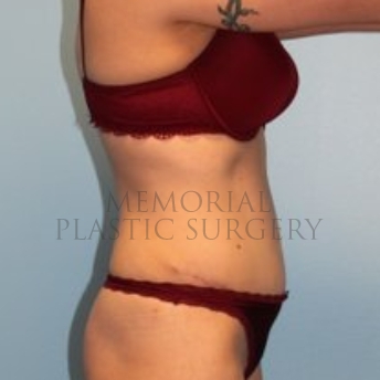 A side view after photo of patient 183 that underwent Abdominoplasty Tummy Tuck:Liposuction procedures at Memorial Plastic Surgery