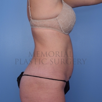 A side view after photo of patient 694 that underwent Abdominoplasty Tummy Tuck:Liposuction procedures at Memorial Plastic Surgery