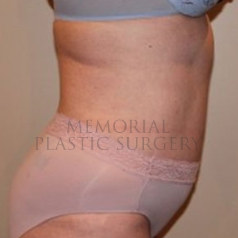 A side view after photo of patient 186 that underwent Abdominoplasty Tummy Tuck:Liposuction procedures at Memorial Plastic Surgery