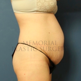 A side view before photo of patient 183 that underwent Abdominoplasty Tummy Tuck:Liposuction procedures at Memorial Plastic Surgery