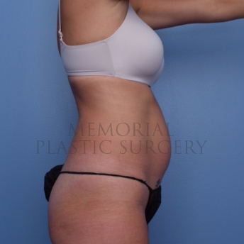 A side view before photo of patient 694 that underwent Abdominoplasty Tummy Tuck:Liposuction procedures at Memorial Plastic Surgery