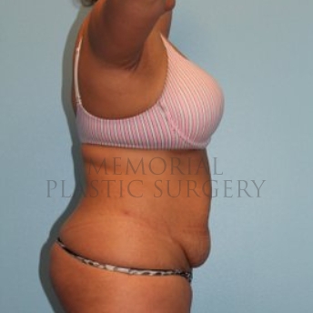 A side view before photo of patient 260 that underwent Abdominoplasty Tummy Tuck:Liposuction procedures at Memorial Plastic Surgery