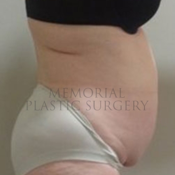 A side view before photo of patient 186 that underwent Abdominoplasty Tummy Tuck:Liposuction procedures at Memorial Plastic Surgery