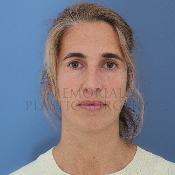 A front view after photo of patient 4124 that underwent Blepharoplasty procedures at Memorial Plastic Surgery
