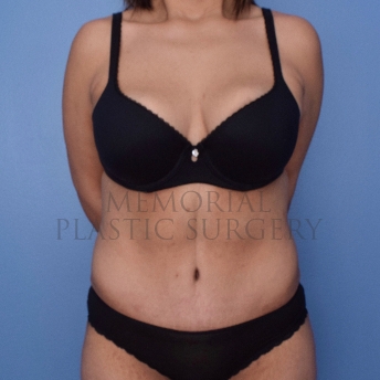 A front view after photo of patient 2654 that underwent Body Lift:Abdominoplasty Tummy Tuck procedures at Memorial Plastic Surgery