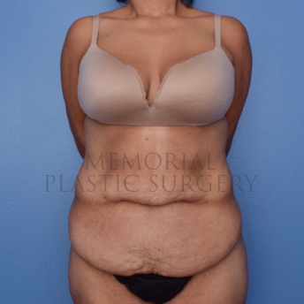 A front view before photo of patient 2654 that underwent Body Lift:Abdominoplasty Tummy Tuck procedures at Memorial Plastic Surgery