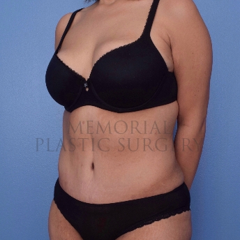 A oblique view after photo of patient 2654 that underwent Body Lift:Abdominoplasty Tummy Tuck procedures at Memorial Plastic Surgery