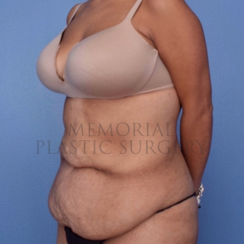 A oblique view before photo of patient 2654 that underwent Body Lift:Abdominoplasty Tummy Tuck procedures at Memorial Plastic Surgery