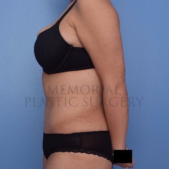 A side view after photo of patient 2654 that underwent Body Lift:Abdominoplasty Tummy Tuck procedures at Memorial Plastic Surgery