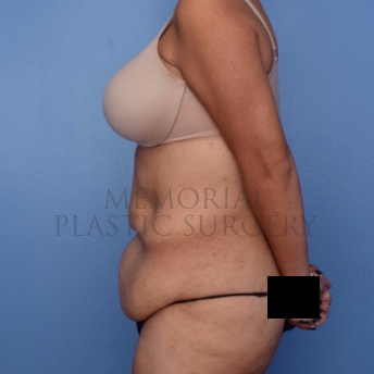 A side view before photo of patient 2654 that underwent Body Lift:Abdominoplasty Tummy Tuck procedures at Memorial Plastic Surgery