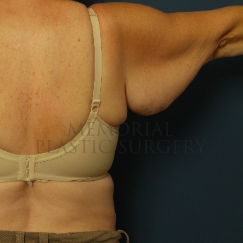 A oblique view before photo of patient 207 that underwent Brachioplasty procedures at Memorial Plastic Surgery
