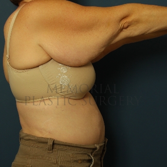 A side view before photo of patient 207 that underwent Brachioplasty procedures at Memorial Plastic Surgery