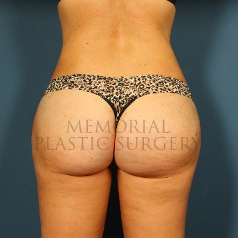 A front view after photo of patient 331 that underwent Brazilian Butt Lift procedures at Memorial Plastic Surgery