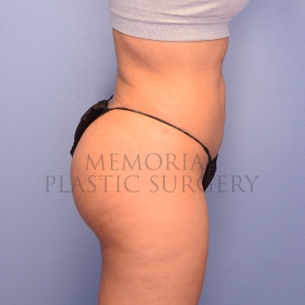 A oblique view after photo of patient 1256 that underwent Brazilian Butt Lift procedures at Memorial Plastic Surgery