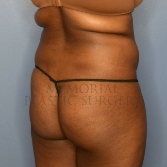 A oblique view before photo of patient 4102 that underwent Brazilian Butt Lift procedures at Memorial Plastic Surgery