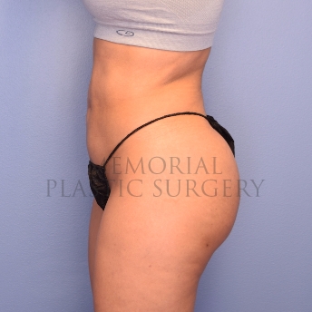 A side view after photo of patient 1256 that underwent Brazilian Butt Lift procedures at Memorial Plastic Surgery