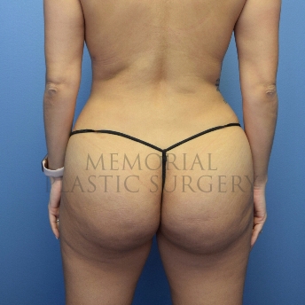 A back view after photo of patient 4103 that underwent Brazilian Butt Lift:Liposuction procedures at Memorial Plastic Surgery
