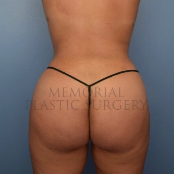 A back view after photo of patient 4104 that underwent Brazilian Butt Lift:Liposuction procedures at Memorial Plastic Surgery