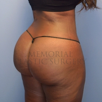 A back view after photo of patient 4105 that underwent Brazilian Butt Lift:Liposuction procedures at Memorial Plastic Surgery