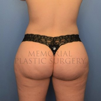 A back view after photo of patient 2519 that underwent Brazilian Butt Lift:Liposuction procedures at Memorial Plastic Surgery