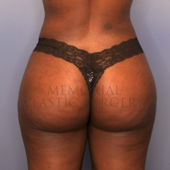 A back view after photo of patient 1413 that underwent Brazilian Butt Lift:Liposuction procedures at Memorial Plastic Surgery