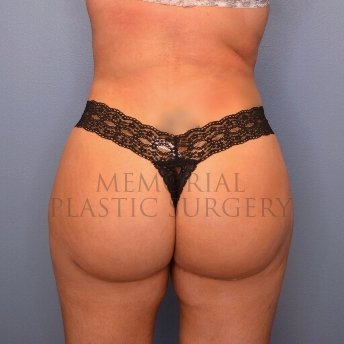 A back view after photo of patient 957 that underwent Brazilian Butt Lift:Liposuction procedures at Memorial Plastic Surgery