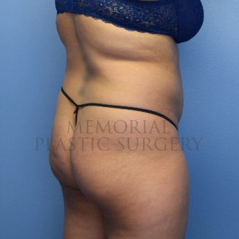 A back view before photo of patient 4107 that underwent Brazilian Butt Lift:Liposuction procedures at Memorial Plastic Surgery