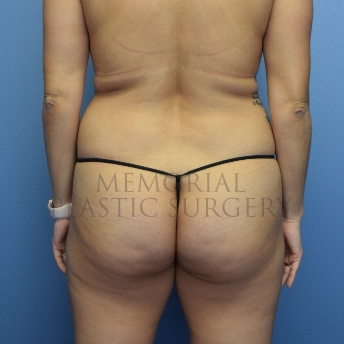 A back view before photo of patient 4103 that underwent Brazilian Butt Lift:Liposuction procedures at Memorial Plastic Surgery