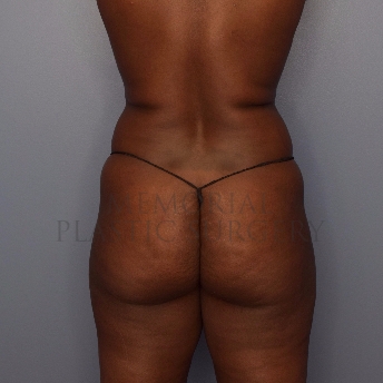 A back view before photo of patient 3025 that underwent Brazilian Butt Lift:Liposuction procedures at Memorial Plastic Surgery