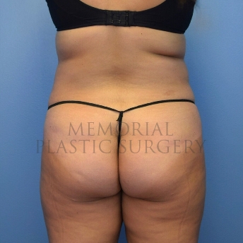 A back view before photo of patient 4104 that underwent Brazilian Butt Lift:Liposuction procedures at Memorial Plastic Surgery