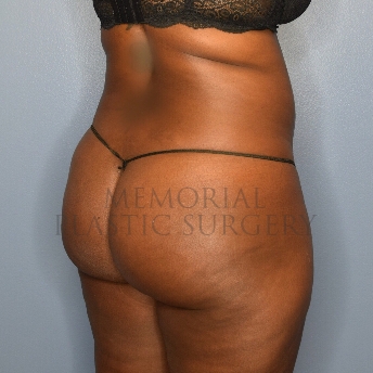 A back view before photo of patient 4105 that underwent Brazilian Butt Lift:Liposuction procedures at Memorial Plastic Surgery