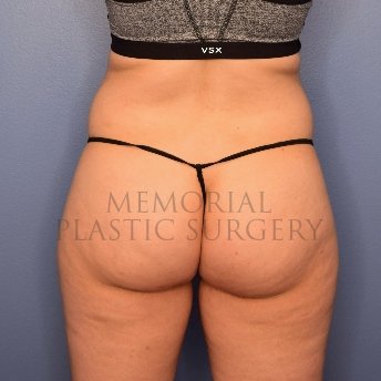 A back view before photo of patient 2519 that underwent Brazilian Butt Lift:Liposuction procedures at Memorial Plastic Surgery