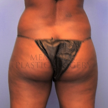 A back view before photo of patient 1413 that underwent Brazilian Butt Lift:Liposuction procedures at Memorial Plastic Surgery