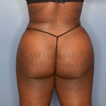 A front view after photo of patient 2652 that underwent Brazilian Butt Lift:Liposuction procedures at Memorial Plastic Surgery