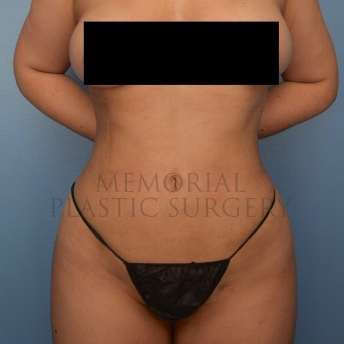 A front view after photo of patient 4104 that underwent Brazilian Butt Lift:Liposuction procedures at Memorial Plastic Surgery