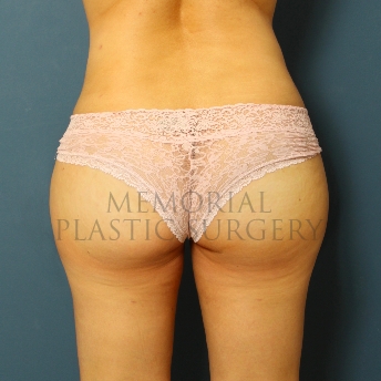 A front view after photo of patient 281 that underwent Brazilian Butt Lift:Liposuction procedures at Memorial Plastic Surgery