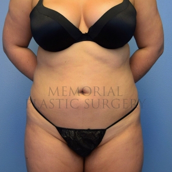A front view before photo of patient 4104 that underwent Brazilian Butt Lift:Liposuction procedures at Memorial Plastic Surgery