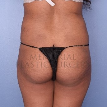 A front view before photo of patient 2523 that underwent Brazilian Butt Lift:Liposuction procedures at Memorial Plastic Surgery